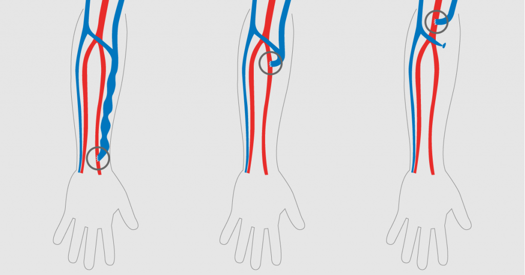 AV fistula construction with VasQ™ – A Pilot Study | Laminate Medical